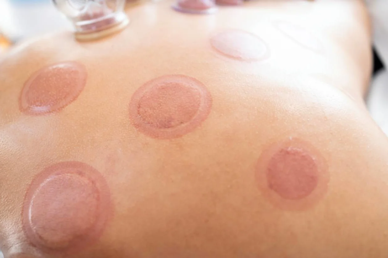 Cupping therapy marks on patient